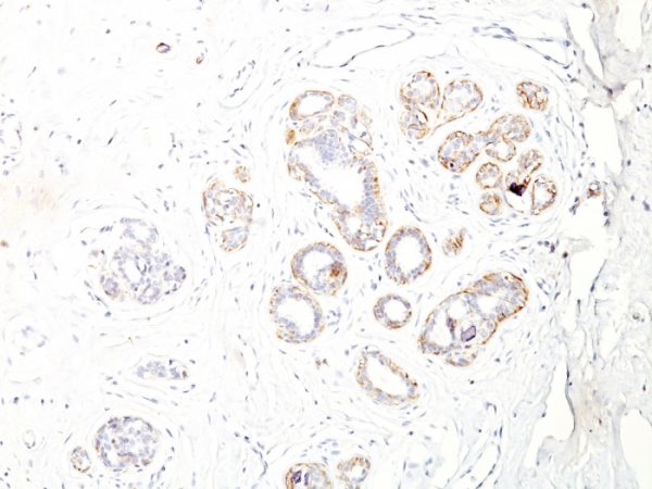 Formalin-fixed, paraffin-embedded human Breast Carcinoma stained with SM-MHC Monoclonal Antibody (ID8).