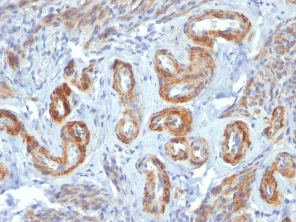 Formalin-fixed, paraffin-embedded human Leiomyosarcoma stained with SM-MHC Monoclonal Antibody (ID8).