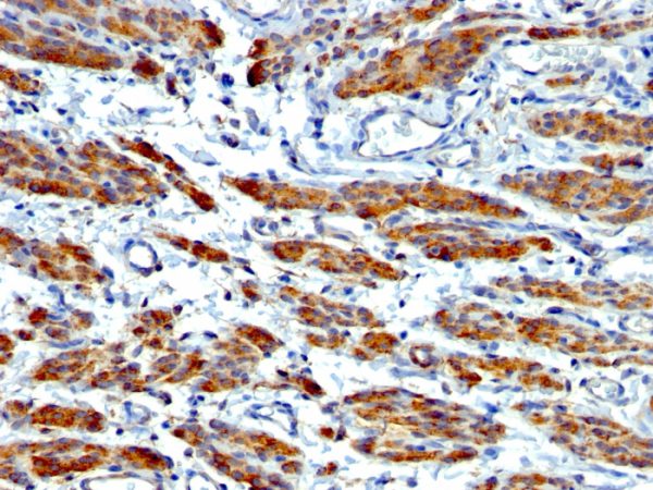 Formalin-fixed, paraffin-embedded human Leiomyosarcoma stained with SM-MHC Monoclonal Antibody (MYH11/923 + SMMS-1).