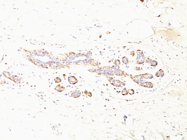 Formalin-fixed, paraffin-embedded human Breast Carcinoma stained with SM-MHC Monoclonal Antibody (MYH11/923 + SMMS-1).