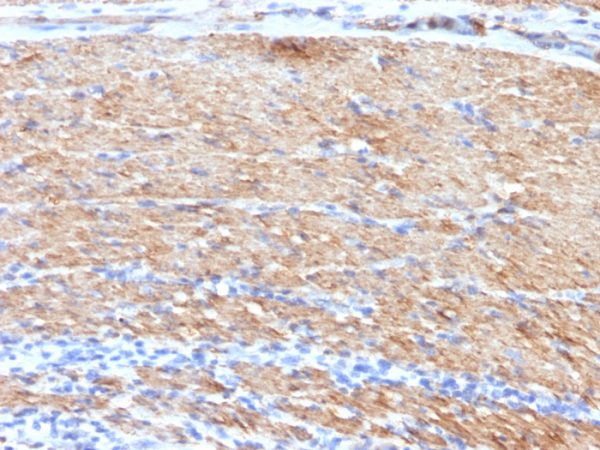 Formalin-fixed, paraffin-embedded human Colon Carcinoma stained with SM-MHC MAb (MYH11/923 + SMMS-1).