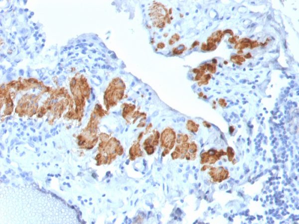 Formalin-fixed, paraffin-embedded human Breast Carcinoma stained with SM-MHC Recombinant Rabbit Monoclonal Antibody (MYH11/2303R).