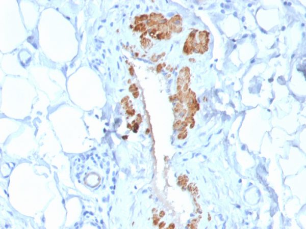 Formalin-fixed, paraffin-embedded human Breast Carcinoma stained with SM-MHC Recombinant Rabbit Monoclonal Antibody (MYH11/2303R).