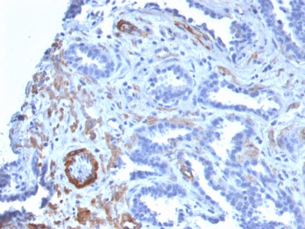 Formalin-fixed, paraffin-embedded human Prostate Carcinoma stained with SM-MHC Recombinant Rabbit Monoclonal Antibody (MYH11/2303R).