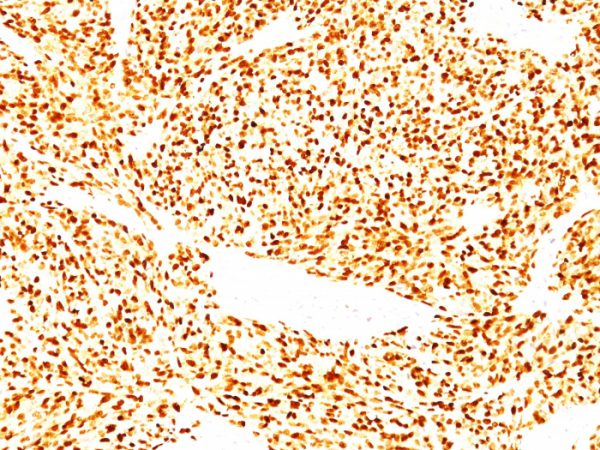 Formalin-fixed, paraffin-embedded human Rhabdomyosarcoma stained with MyoD1 Mouse Monoclonal Antibody (SPM427).