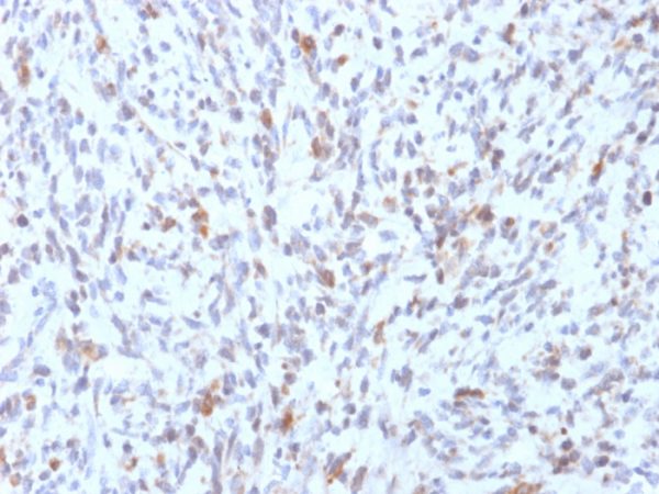 Formalin-fixed, paraffin-embedded human Rhabdomyosarcoma stained with MyoD1 Mouse Recombinant Monoclonal Antibody (rMYD712).