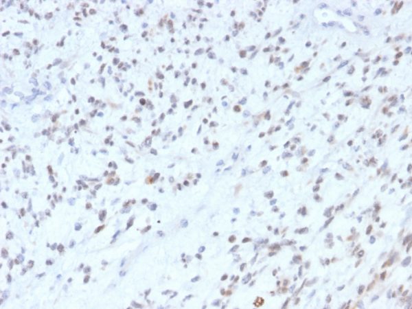 Formalin-fixed, paraffin-embedded human rhabdomyosarcoma stained with MyoD1 Recombinant Rabbit Monoclonal Antibody (MYOD1/2075R).