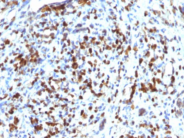 Formalin-fixed, paraffin-embedded human rhabdomyosarcoma stained with MyoD1 Recombinant Rabbit Monoclonal Antibody (MYOD1/2075R).