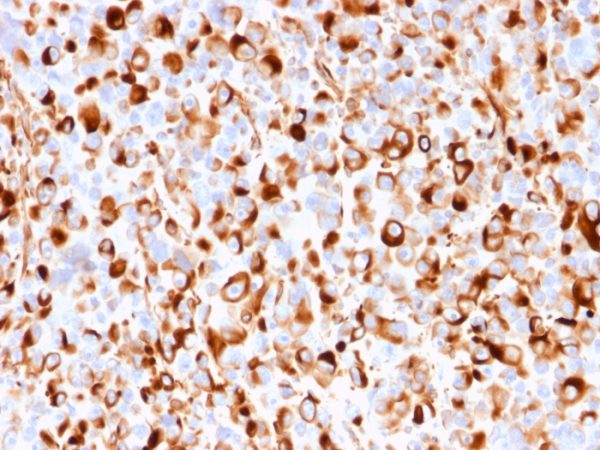 Formalin-fixed, paraffin-embedded human melanoma stained with NGFR Recombinant Mouse Monoclonal Antibody (rNGFR/1965).