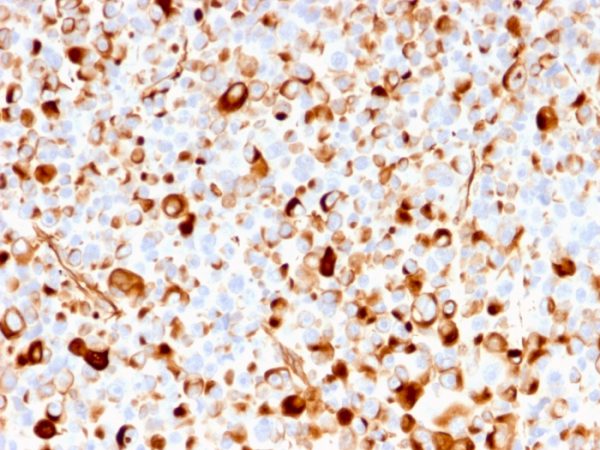 Formalin-fixed, paraffin-embedded human melanoma stained with NGFR Recombinant Mouse Monoclonal Antibody (rNGFR/1965).