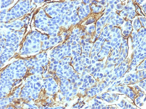 Formalin-fixed, paraffin-embedded human Melanoma stained with NGFR Monoclonal Antibody (NTR/912).