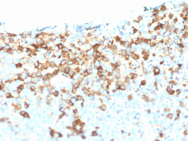 Formalin-fixed, paraffin-embedded human Melanoma stained with NGFR Mouse Monoclonal Antibody (NGFR/1964).