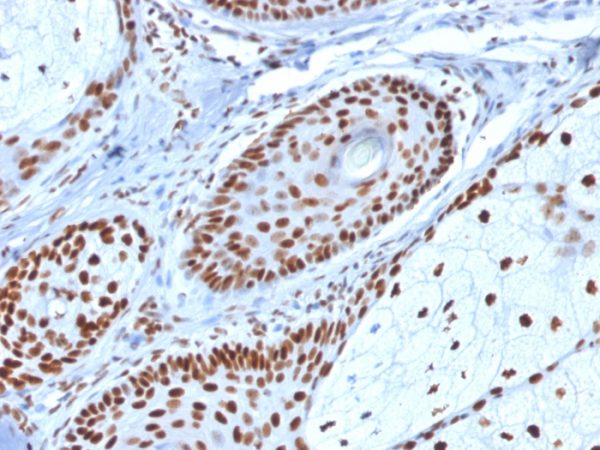 Formalin-fixed, paraffin-embedded human Basal Cell Carcinoma stained with Nucleophosmin-Monospecific Mouse Monoclonal Antibody (NPM1/1902).