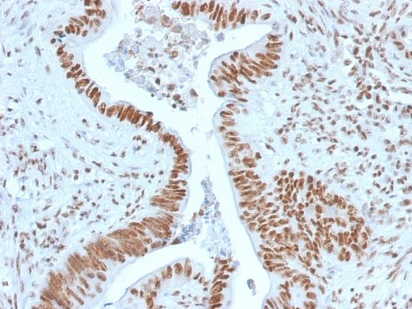 Formalin-fixed, paraffin-embedded human colon carcinoma stained with Nucleophosmin-Monospecific Mouse Monoclonal Antibody (NPM1/1902).