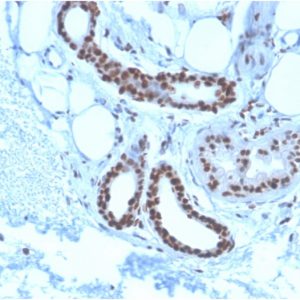 Formalin-fixed, paraffin-embedded human Basal Cell Carcinoma stained with Nucleophosmin-Monospecific Mouse Monoclonal Antibody (NPM1/3285).
