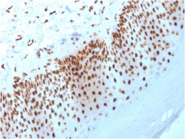 Formalin-fixed, paraffin-embedded human Basal Cell Carcinoma stained with Nucleophosmin Mouse Monoclonal Antibody (NPM1/3398).