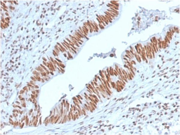 Formalin-fixed, paraffin-embedded human ColonCarcinoma stained with Nucleophosmin Mouse Monoclonal Antibody (NPM1/3398).