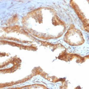 Formalin-fixed, paraffin-embedded human Prostate Carcinoma stained with YBX1 Mouse Recombinant Monoclonal Antibody (rYBX1/2430).