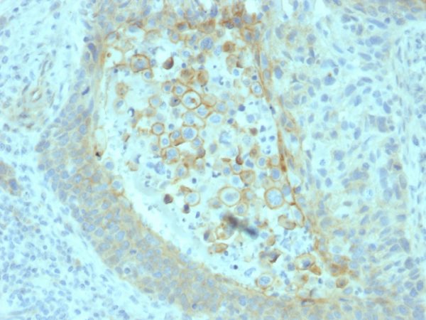 Formalin-fixed, paraffin-embedded human Pancreatic Carcinoma stained with CD73 Mouse Monoclonal Antibody (NT5E/2545).