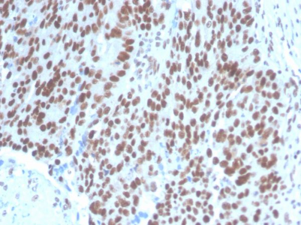 Formalin-fixed, paraffin-embedded human Ovarian Carcinoma stained with PAX2 Mouse Monoclonal Antibody (PAX2/1104).