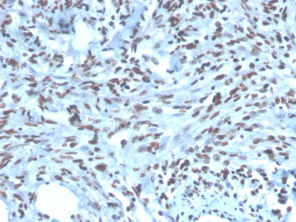 Formalin-fixed, paraffin-embedded human Renal Cell Carcinoma stained with PAX2 Mouse Monoclonal Antibody (PAX2/1104).