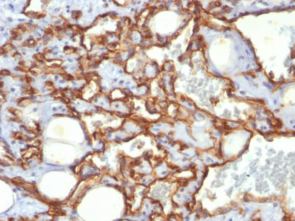 Formalin-fixed, paraffin-embedded human Angiosarcoma stained with CD31 Monoclonal Antibody (SPM532)