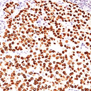 Formalin-fixed, paraffin-embedded human breast carcinoma stained with Progesterone Receptor Mouse Monoclonal Antibody (SPM566).