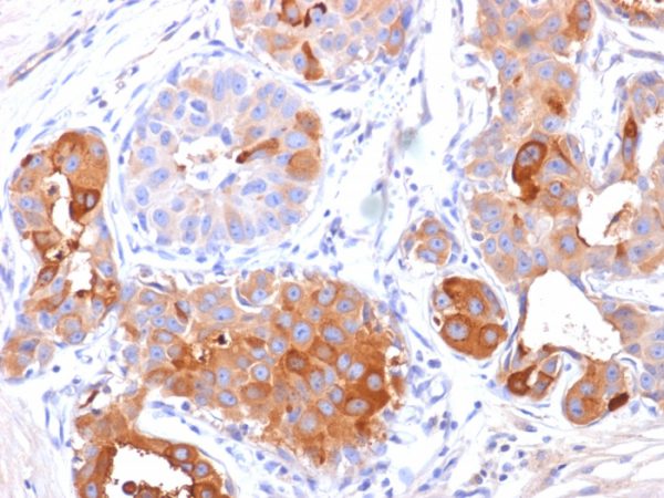 Formalin-fixed, paraffin-embedded human breast carcinoma stained with GCDFP-15 Mouse Monoclonal Antibody (PIP/1571). HIER: Tris/EDTA, pH9.0, 45min. 2°C: HRP-polymer, 30min. DAB, 5min.