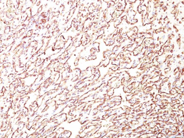 Formalin-fixed, paraffin-embedded human Angiosarcoma stained with Podocalyxin Monoclonal Antibody (4F10).