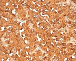 Formalin-fixed, paraffin-embedded human pituitary tumor stained with ACTH Recombinant Mouse Monoclonal Antibody (rCLIP4278). HIER: Tris/EDTA, pH9.0, 45min. 2°C: HRP-polymer, 30min. DAB, 5min.