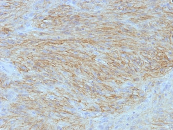 Formalin-fixed, paraffin-embedded human GIST stained with DOG1 Monoclonal Antibody (SPM580).