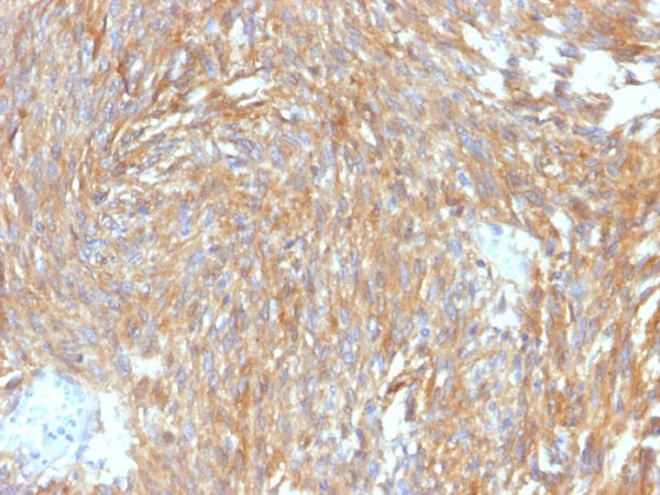 Formalin-fixed, paraffin-embedded human GIST stained with DOG-1 Rabbit Recombinant Monoclonal Antibody (DG1/2564R).