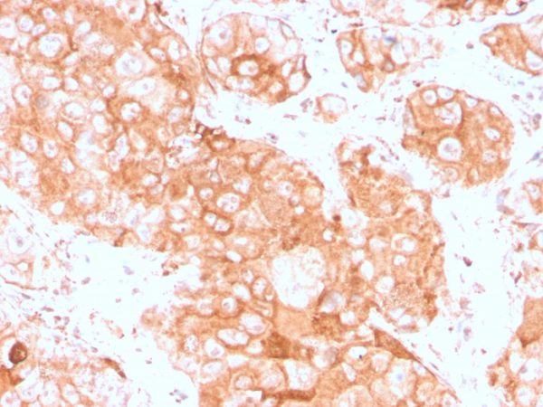 Formalin-fixed, paraffin-embedded human testicular carcinoma stained with Prolactin Receptor Recombinant Rabbit Monoclonal (PRLR3785R).