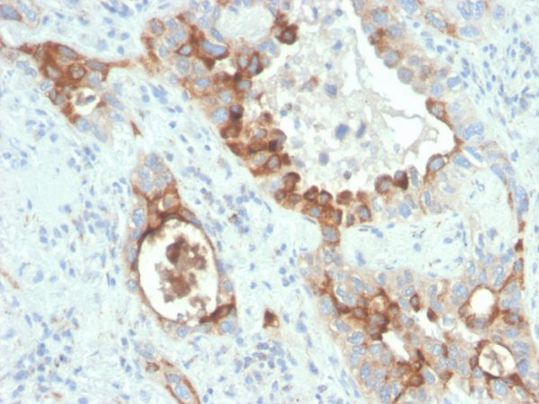 Formalin-fixed, paraffin-embedded human colon carcinoma stained with PMEPA1 Recombinant Mouse Monoclonal (rPMEPA1/6422).