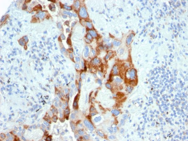 Formalin-fixed, paraffin-embedded human colon carcinoma stained with PMEPA1 Mouse Monoclonal Antibody (PMEPA1/2696).