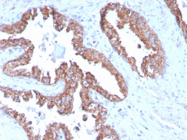 Formalin-fixed, paraffin-embedded human prostate carcinoma stained with PMEPA1 Mouse Monoclonal Antibody (PMEPA1/2696).