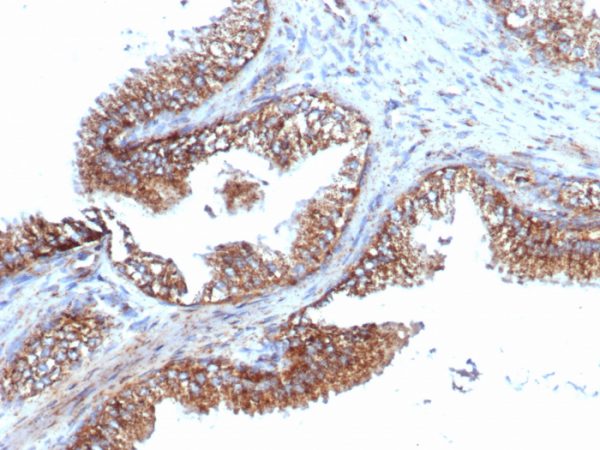 Formalin-fixed, paraffin-embedded human prostate carcinoma stained with PMEPA1 Recombinant Rabbit Monoclonal Antibody (PMEPA1/6421R).