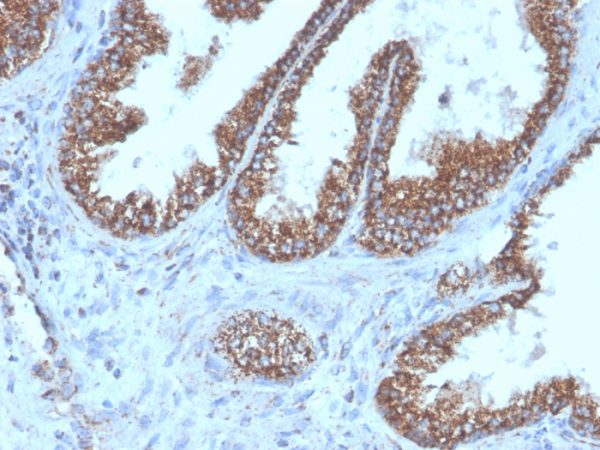 Formalin-fixed, paraffin-embedded human prostate carcinoma stained with PMEPA1 Recombinant Rabbit Monoclonal Antibody (PMEPA1/6421R).