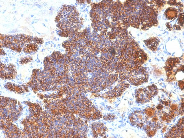 Formalin-fixed, paraffin-embedded human Parathyroid stained with PTH Monoclonal Antibody (PTH/1174).