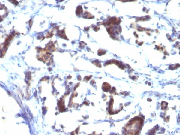 Formalin-fixed, paraffin-embedded human Gastric Carcinoma stained with ZFYVE28 Mouse Monoclonal Antibody (LST2/2426)