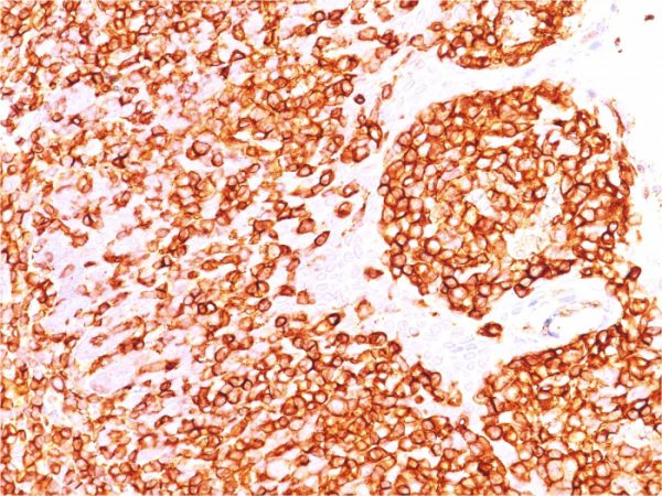 Formalin-fixed, paraffin-embedded human Tonsil stained with CD45 Mouse Recombinant Monoclonal Antibody (rPTPRC/1460).