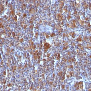 Formalin-fixed, paraffin-embedded Hodgkin&apos;s Lymphoma stained with BAX Mouse Monoclonal Antibody (BAX/962).