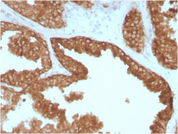 Formalin-fixed, paraffin-embedded human Prostate Carcinoma stained with RET Mouse Monoclonal Antibody (RET/2795).