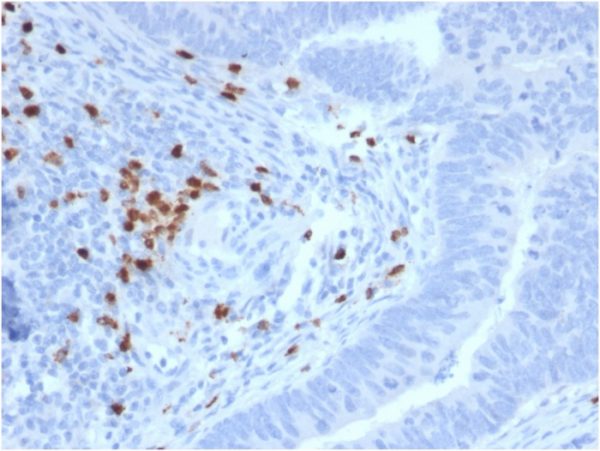 Formalin-fixed, paraffin-embedded human Colon Carcinoma stained with RET Mouse Monoclonal Antibody (RET/2795).