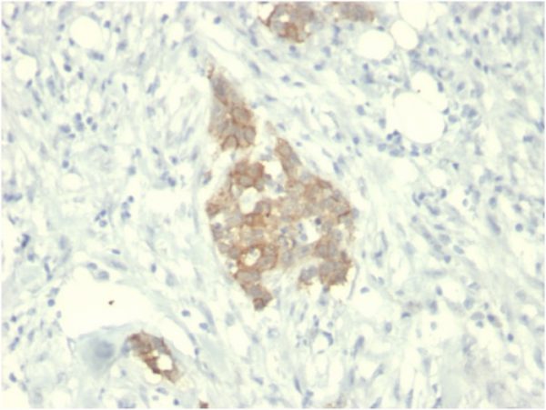 Formalin-fixed, paraffin-embedded human Breast Carcinoma stained with RET Mouse Monoclonal Antibody (RET/2795).