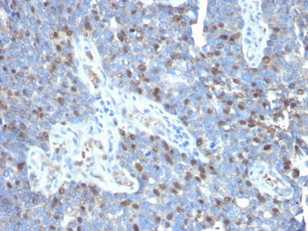 Formalin-fixed, paraffin-embedded human colon carcinoma stained with ROR-gamma / RORC Mouse Monoclonal Antibody (RORC/2941).