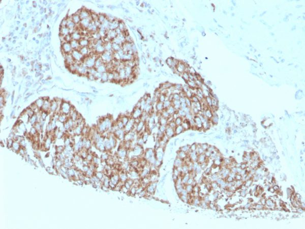 Formalin-fixed, paraffin-embedded human breast cancer stained with Calprotectin Mouse Monoclonal Antibody (S100A9/1075). HIER: Tris/EDTA, pH9.0, 45min. 2°C: HRP-polymer, 30min. DAB, 5min.