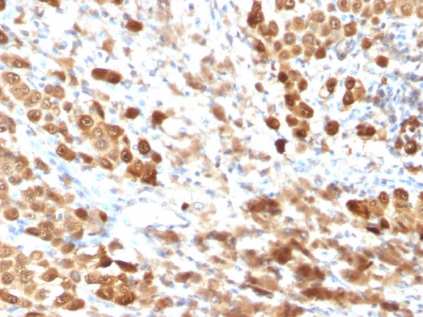 Formalin-fixed, paraffin-embedded human Melanoma stained with S100B Mouse Monoclonal Antibody (SPM354).