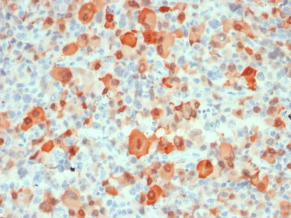 Formalin-fixed, paraffin-embedded human melanoma stained with S100B Mouse Recombinant Monoclonal Antibody (rS100B/1896).