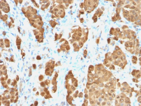 Formalin-fixed, paraffin-embedded human melanoma stained with S100B Recombinant Rabbit Monoclonal Antibody (S100B/1706R).